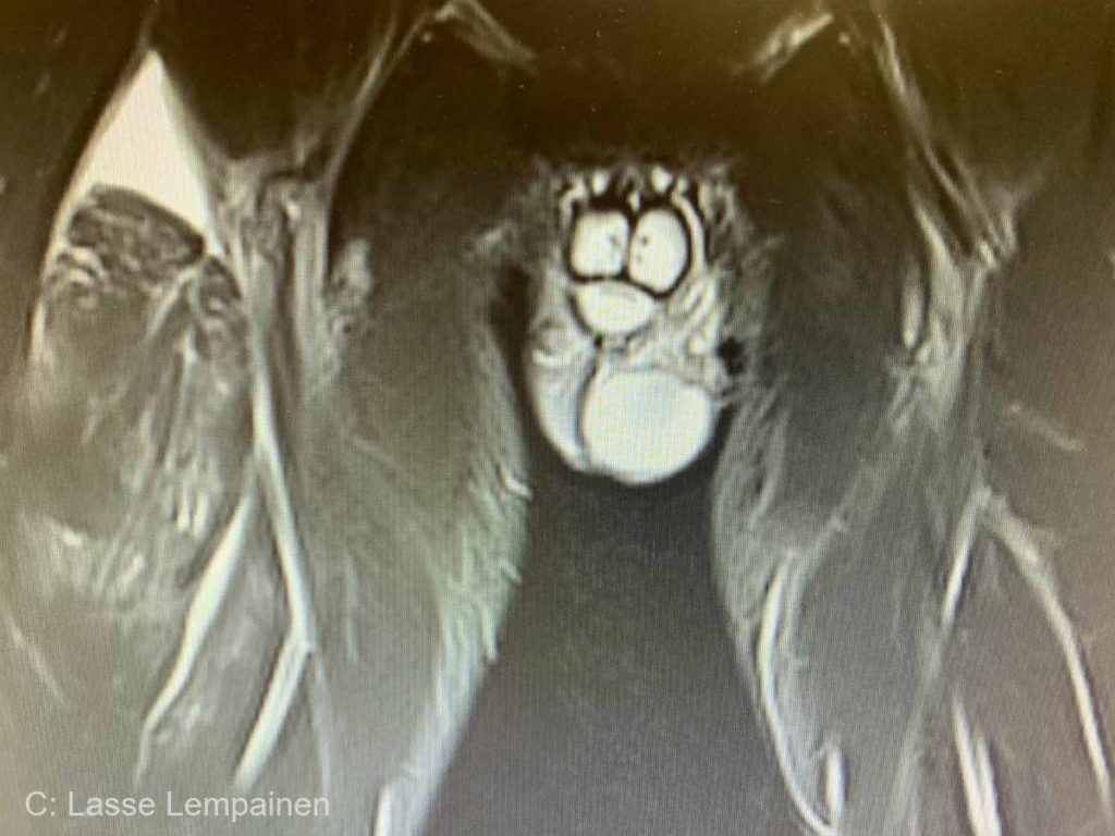 Rectus Femoris Muscle Tear